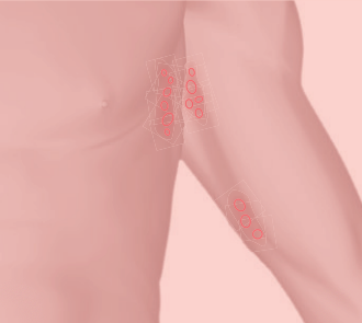 ganglion aisselle